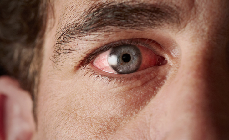 גבר עם עין ירוקה הסובל מיובש בעיניים