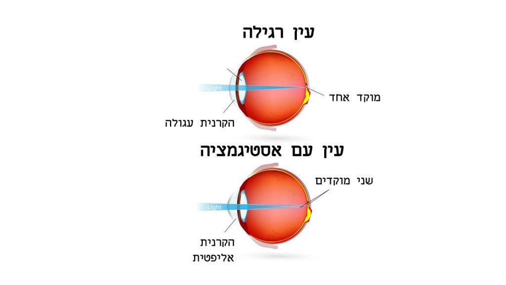 עדשות מגע עבור צילינדר בעין