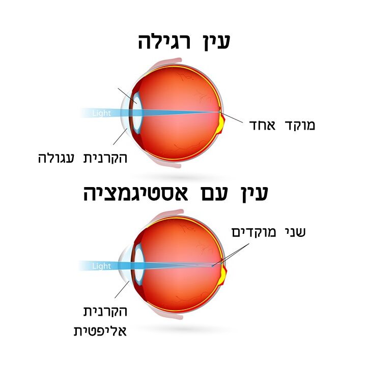 הדמייה אסטיגמציה גבוהה על ידי ארזה פרוכטר