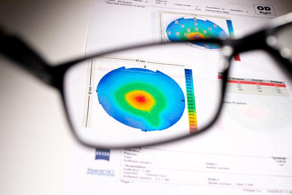 משקפיים לחולי קרטוקונוס