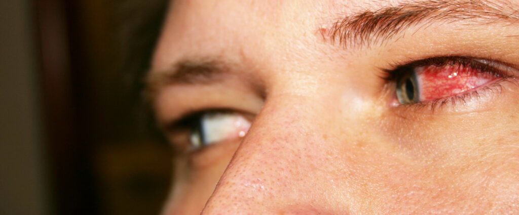 מחלות עיניים תורשתיות